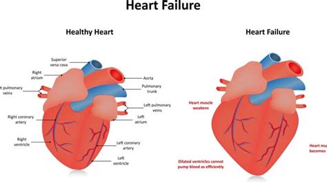 inferior wall hypokinesis definition.